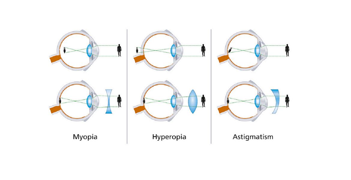 Facts Of Refractive Error - Remove it By RX Safety Glasses