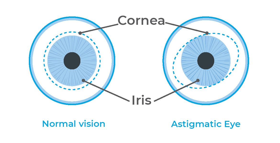 What Do You Know About Astigmatism and How to Correct It?