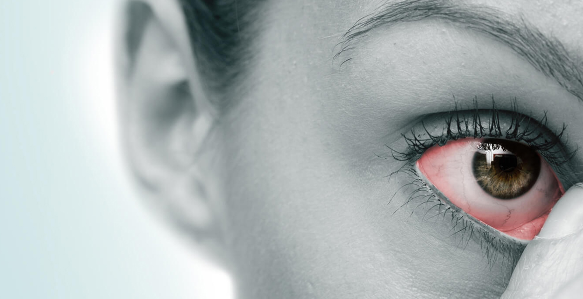 What is Dry Eye Syndrome? and How to Protect Yourself from Dry Eyes?