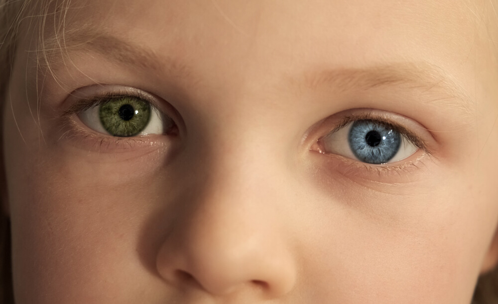 Unlocking the Enigma: Understanding Heterochromia - A Comprehensive Exploration