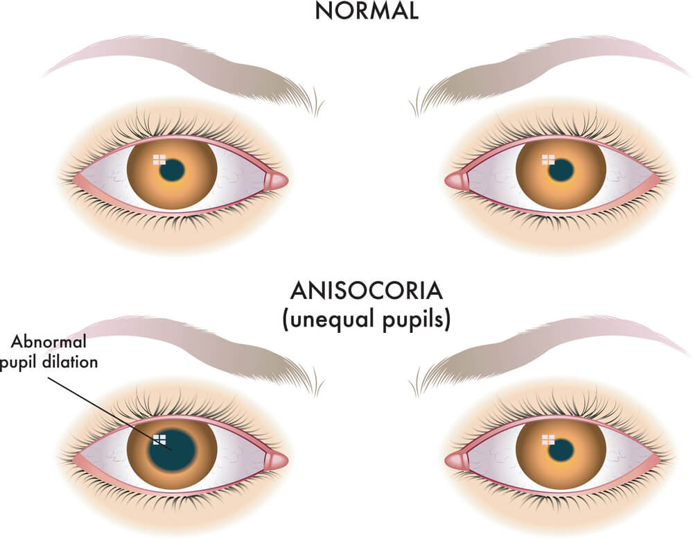 How To Make Eye Dilation Go Away Faster