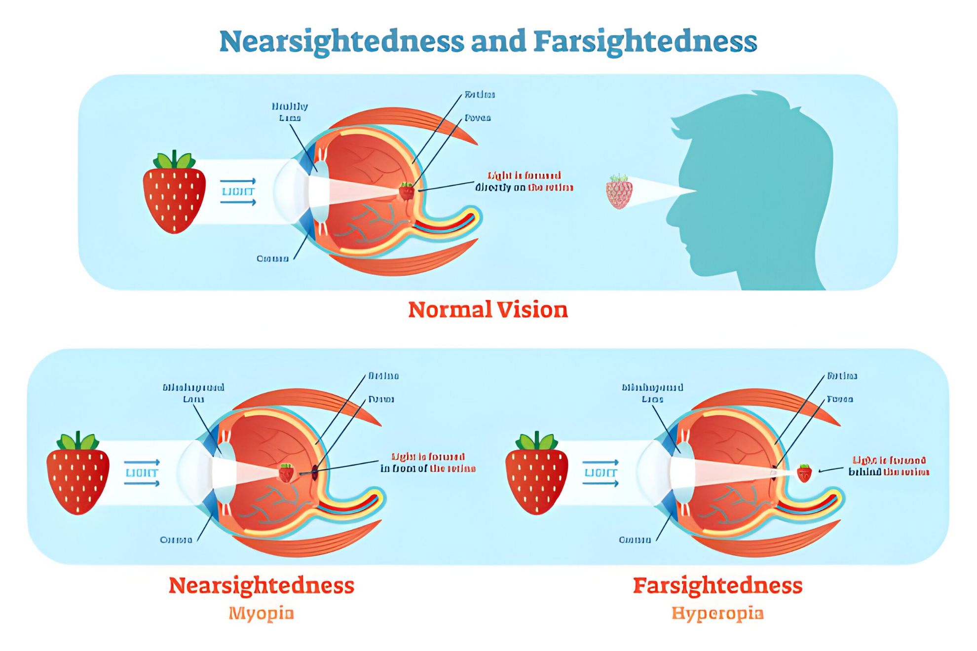 Nearsighted Vs Farsighted, Which Is More Common